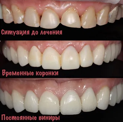 Узнайте зачем нужны временные коронки на зубы, на импланты