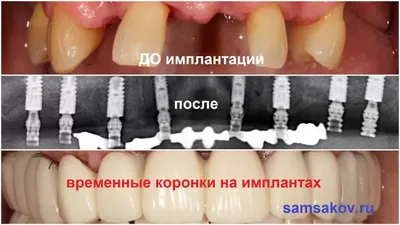 Протезирование молочных зубов в Москве - Стоматология Май