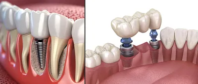 Частичные съемные протезы: виды, преимущества и показания.
