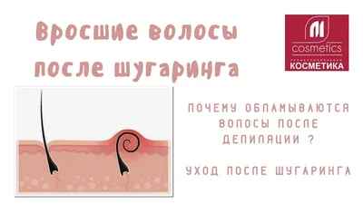 УДАЛЕНИЕ ВРОСШИХ ВОЛОС С ПОМОЩЬЮ ЛАЗЕРНОЙ ЭПИЛЯЦИИ - статьи центра лазерной  и медицинской косметологии \"МедЭстетик\"