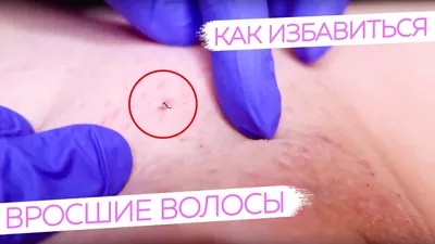 Вросшие волосы после шугаринга. Способы борьбы! | LIMERENCE_BEAUTY | Дзен