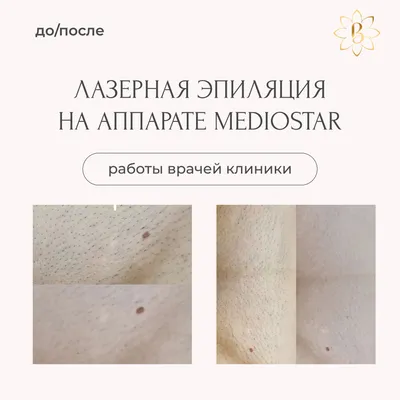 Nano Sugaring - новое поколение сахарной пасты - МЫ УЖЕ НАЧАЛИ, НО ВЫ ЕЩЕ  МОЖЕТЕ УСПЕТЬ! 🤔Вы знаете чем отличается кистозный вросший волос от  комедоноподобного и папулопустульного? А как предупредить появление любого