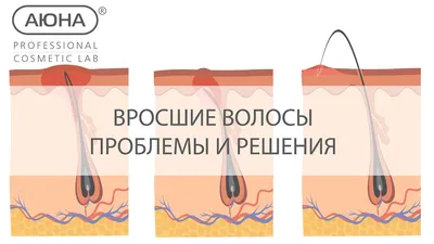 ЛАЗЕРНАЯ ЭПИЛЯЦИЯ ВОРОНЕЖ on Instagram: \"ВРОСШИЕ ВОЛОСЫ ⠀ Вросшие волосы —  частая проблема после бритья, шугаринга или восковой депиляции. За вросшими  волосками следуют покраснения и раздражение кожи, могут появиться рубцы,  бывают даже