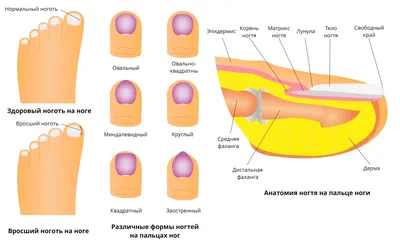 Удаление вросшего ногтя - лечение онихокриптоза, лазерное или радиоволновое  удаление