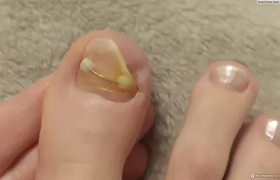 Безболезненное лечение вросшего ногтя на ноге - Скоба Фрезера - «В процессе  лечения вросшего ногтя скобой Фрейзера » | отзывы