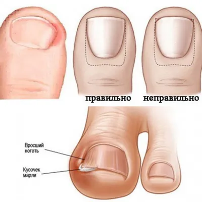 Удаление вросшего ногтя лазером - цена лечения в СПб