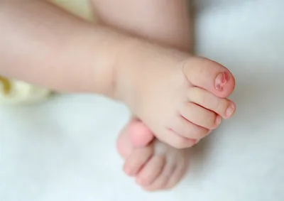 Методы лечения онихокриптоза (вросшего ногтя) у детей ✓ Авторские статьи  Клиники Подологии