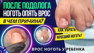 Вросший ноготь у ребенка | Услуги Подолога, Москва, Подольск, Щербинка