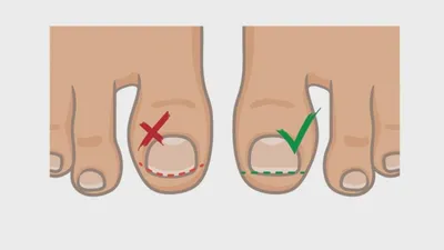Вросший ноготь (онихокриптоз) - все о заболевании простыми словами