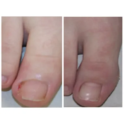 Почему скручиваются ногти – причины, способы лечения и профилактика проблемы
