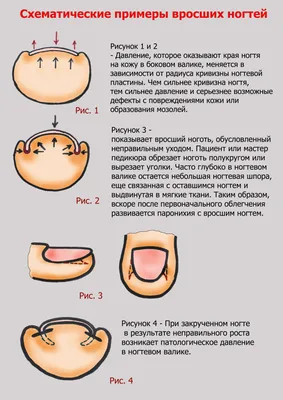 Почему врастает ноготь и как эффективно лечить вросший ноготь?