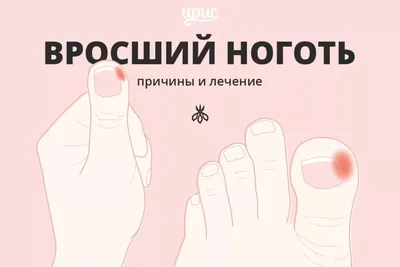 Вросший ноготь (онихокриптоз) | Центр подологии и остеопатии Татьяны Красюк