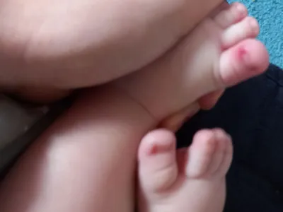 Лечение вросшего ногтя у детей в Туле - Центр подологии Доктора Дато