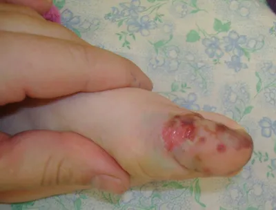 Как вылечить и восстановить ноготь при панариции — блог медицинского центра  ОН Клиник