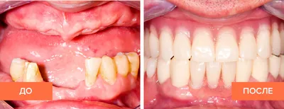 Частичный съемный протез зубов – виды, фото, отзывы