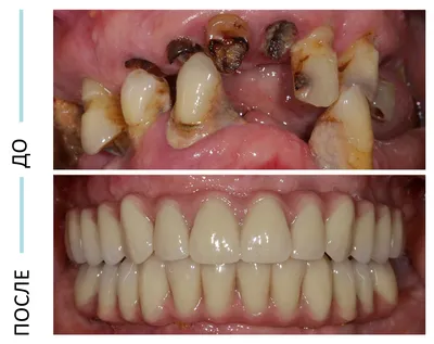 Протезирование зубов в Санкт-Петербурге (съемное и несъемное) по доступным  ценам