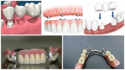 Вставные зубы – протезирование, имплантация