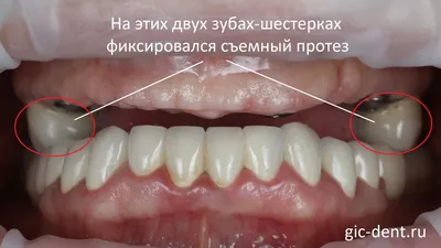 Варианты замены полного отсутствия зубов имплантами и протезированием –  Немецкий имплантологический центр, Москва