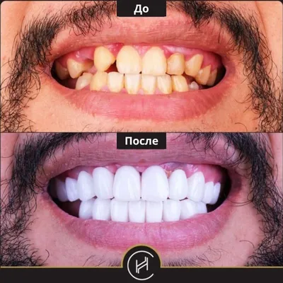 Зубные импланты в Турции - Клиника Heva