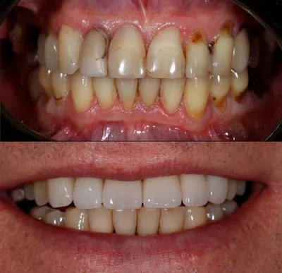 Изменение лица и улыбки после несъемных протезов на имплантах Клинический  случай