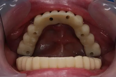 Съемные зубные протезы и их минусы, плюсы несъемного протезирования зубов от  Dominanta