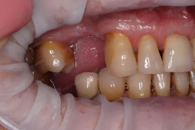 Съемные зубные протезы на верхнюю челюсть: какой материал выбрать?