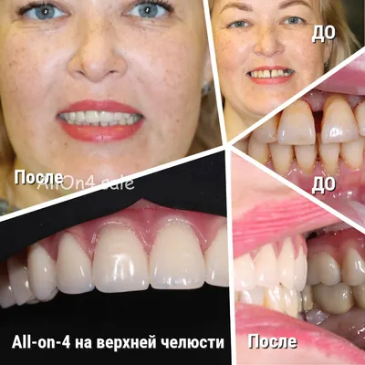 Имплантация верхних зубов - особенности, методы, цены | НАВА