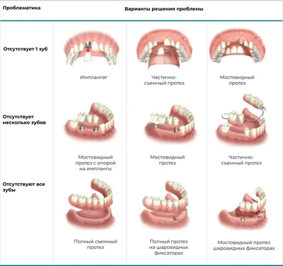 Съемные зубные протезы и их минусы, плюсы несъемного протезирования зубов от  Dominanta