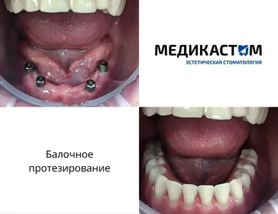 Вставить зубы: цена в Харькове на протезирование и имплантацию