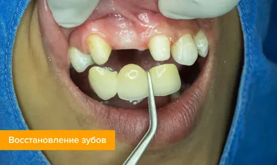 Протезирование челюсти при полном отсутствии зубов: цены в Медикастом