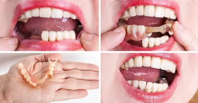 Вставить зубы – какие лучше?