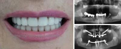 Протезирование челюсти при отсутствии всех зубов - интервью израильского  имплантолога