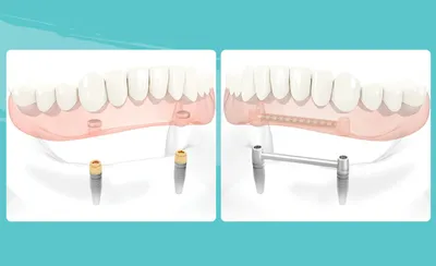 Протезирование зубов на имплантах, виды и цены протезов