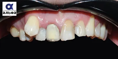Зубные протезы стучат при жевании