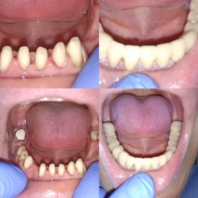 ᐉ Протезирование зубов Днепр • ЦЕНЫ от 2550 грн • Вставить зуб в Днепре •  Съемные зубные протезы в Днепре | Стома Сервис