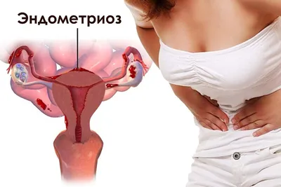Эндометриоз матки: симптомы и лечение в клинике Репромед