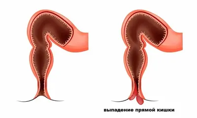 Выпадение прямой кишки (ректальный пролапс): причины, симптомы и лечение