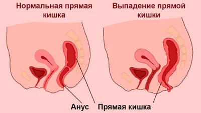 Выпадение прямой кишки(ректальный пролапс): причины, симптомы и лечение  болезни