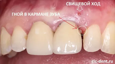 Атравматичное удаление зубов мудрости. Правила и рекомендации.