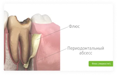 Прорезывание зуба мудрости – симптомы, время, осложнения