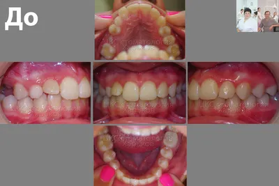 Пародонтит зуба (десен) — лечение, симптомы (хронический,  генерализованный), степени