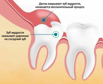 О стоматологии и не только...: Ретинированный клык, вытягивание