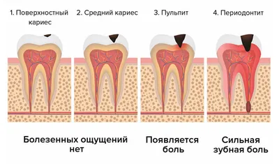 Сложное удаление зуба мудрости: особенности операции