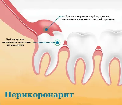 Как понять, что растет зуб мудрости – статьи стоматологической клиники  «Доктор Мартин»