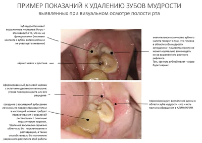 Периодонтит - что это, осложнения, лечение -