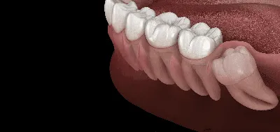 Экзостоз после удаления зуба, выпирает кость что делать?