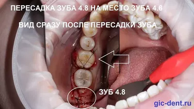 Удаление зубов мудрости. Показания, особенности, осложнения