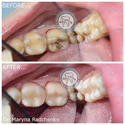 Современная стоматология: одномоментная имплантация зуба и наращивание  челюстной кости глазами технического директора / Хабр