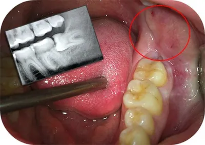 Удаление зуба. Осложнение - Центр ортодонтии №1