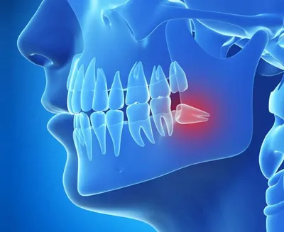 Зуб мудрости растет и болит десна: что делать, как снять боль | Dental Art